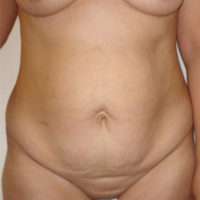 Abdominoplasty