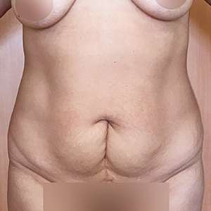 Abdominoplasty