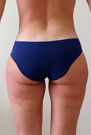 Bodytite Cellulite