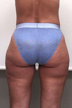 Bodytite Cellulite