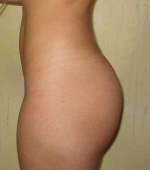 Butt Augmentation