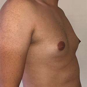 Gynecomastia