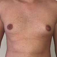 Gynecomastia