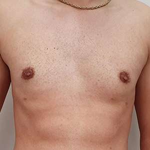 Gynecomastia