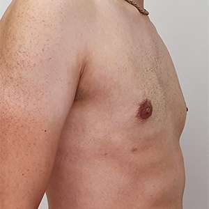 Gynecomastia