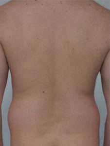 Smart Lipolysis Guadalajara