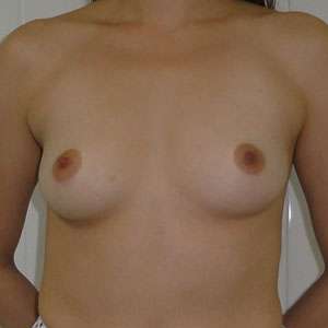 Breast Augmentation Case 7710 Before Photo Breast Augmentation
