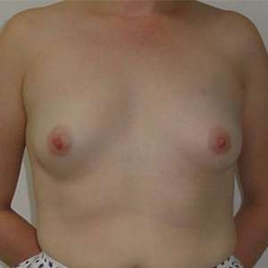 Breast Augmentation Case 7719 Before Photo Breast Augmentation