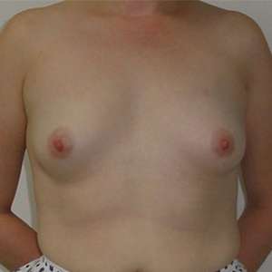 Breast Augmentation