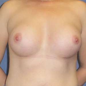 Breast Augmentation Case 7719 After Photo Breast Augmentation