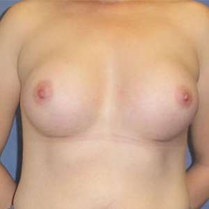 Breast Augmentation