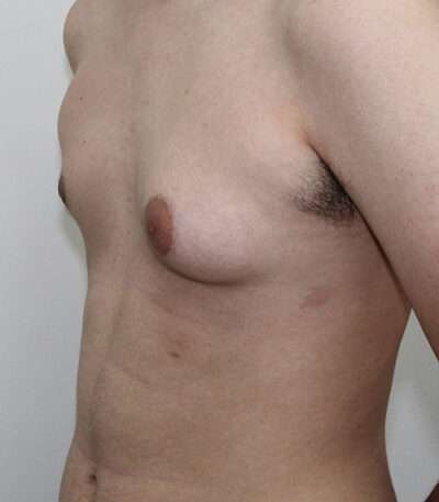 Gynecomastia Case 16308 Before Photo Gynecomastia