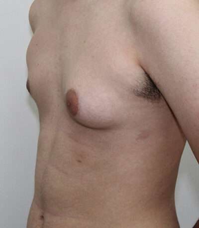 Gynecomastia