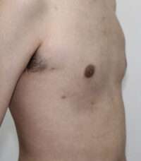 Gynecomastia