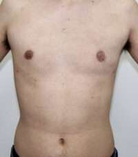 Gynecomastia