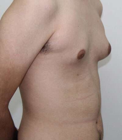 Gynecomastia Case 16308 Before Photo Gynecomastia