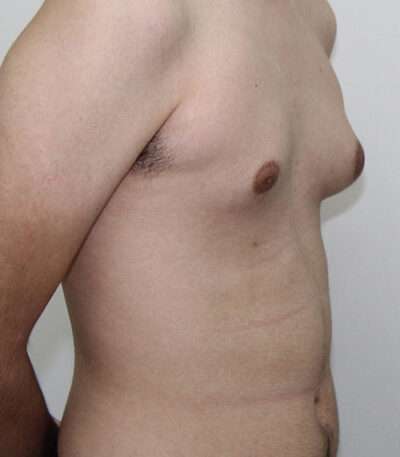 Gynecomastia