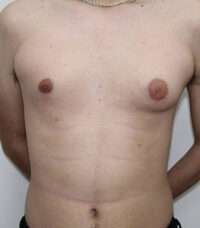 Gynecomastia