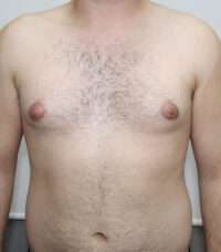 Gynecomastia