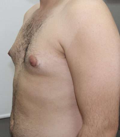 Gynecomastia Case 16328 Before Photo Gynecomastia
