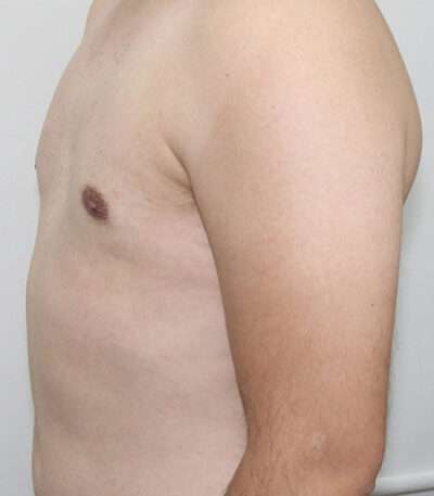 Gynecomastia Case 16328 After Photo Gynecomastia