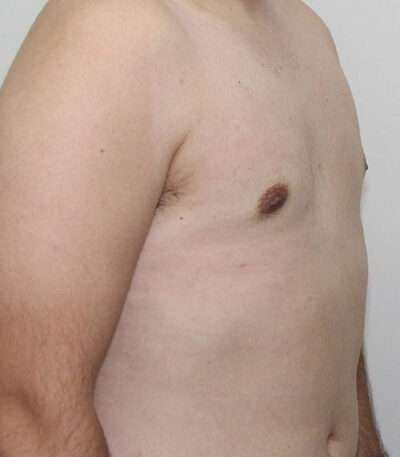 Gynecomastia