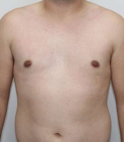 Gynecomastia