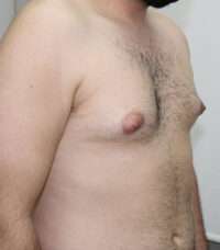 Gynecomastia