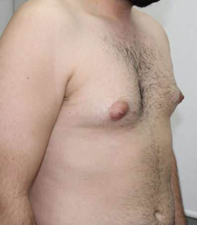 Gynecomastia Case 16328 Before Photo Gynecomastia
