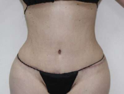 Abdominoplasty