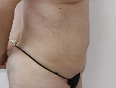 Abdominoplasty