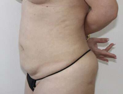 Abdominoplasty