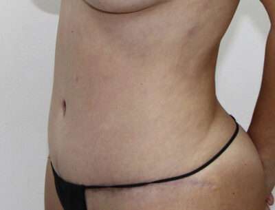 Abdominoplasty Case 16348 After Photo Abdominoplasty
