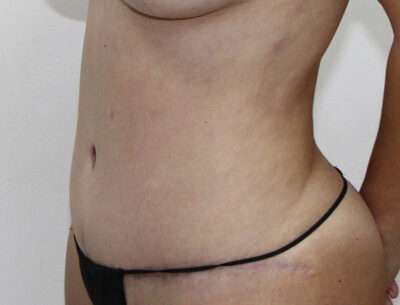 Abdominoplasty