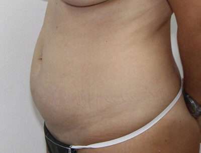 Abdominoplasty