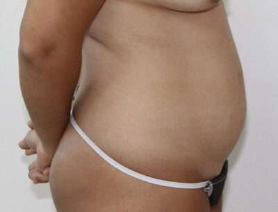 Abdominoplasty Case 16348 Before Photo Abdominoplasty