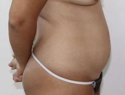 Abdominoplasty