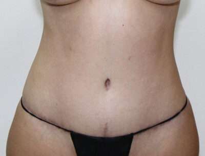 Abdominoplasty Case 16348 After Photo Abdominoplasty