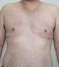 Gynecomastia
