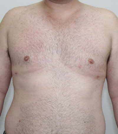 Gynecomastia