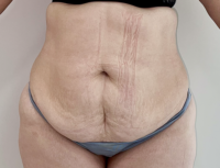 Abdominoplasty