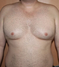 Gynecomastia