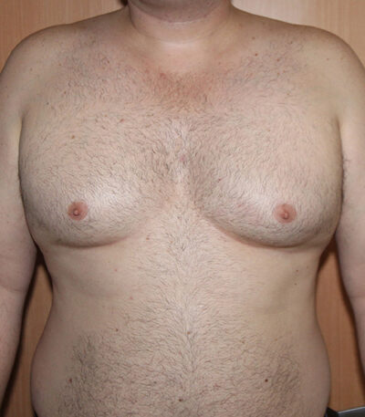 Gynecomastia