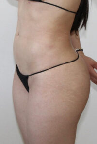Butt Augmentation