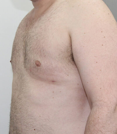Gynecomastia