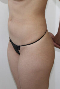 Butt Augmentation