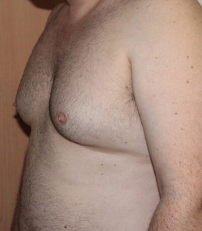 Gynecomastia