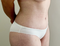 Abdominoplasty