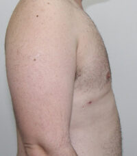 Gynecomastia