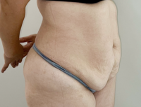 Abdominoplasty